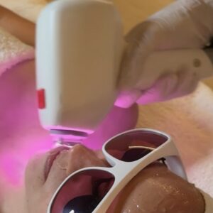 Regala Fotorejuvenecimiento Facial completo con LÁSER de DIODO